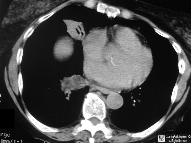 Lipoid Pneumonia